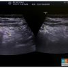 Nhồi máu mạc nối - Ảnh 3