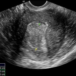 Polyp nội mạc tử cung