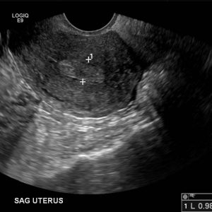 Polyp nội mạc tử cung