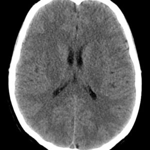 Tổn thương sợi trục lan tỏa