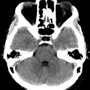 Huyết khối TM não