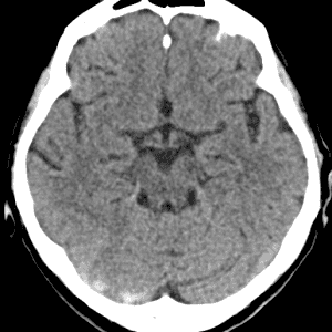 Huyết khối TM não