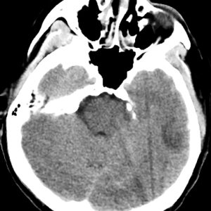 Huyết khối tĩnh mạch não