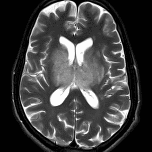 Huyết khối TM não