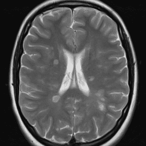 Xơ cứng rải rác