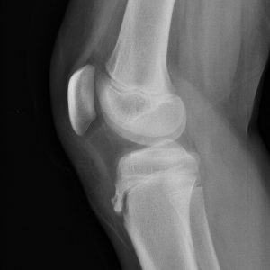 Osgood – Schlatter