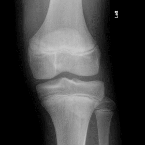 Viêm lồi củ trước xương chày