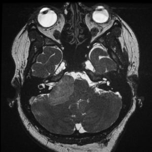 Xâm lấn tối thiểu lỗ tai trong