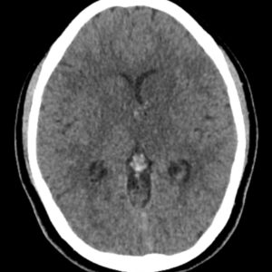 Huyết khối tĩnh mạch não