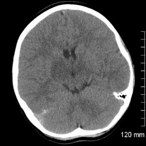 Huyết khối tĩnh mạch não