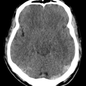 Huyết khối tĩnh mạch não