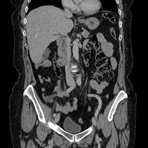 Manh tràng + Đại tràng lên