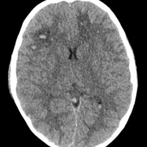 Chấn thương sọ não