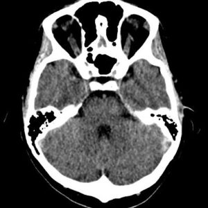 Huyết khối tĩnh mạch não