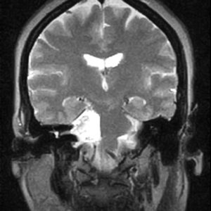 U nang bì nội sọ