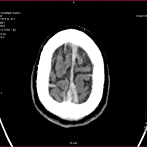 Huyết khối tĩnh mạch não