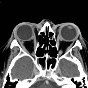Huyết khối xoang hang