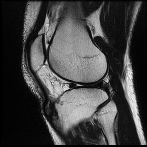 Osgood Schlatter