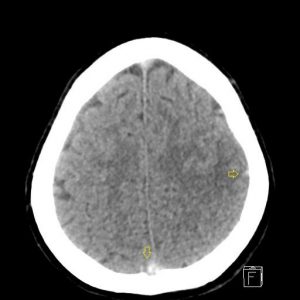 Huyết khối tĩnh mạch não