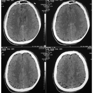 Tổn thương sợi trục