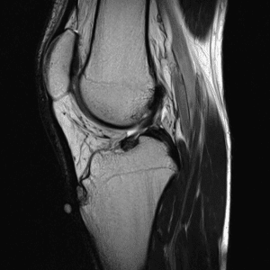 Osgood-Schlatter