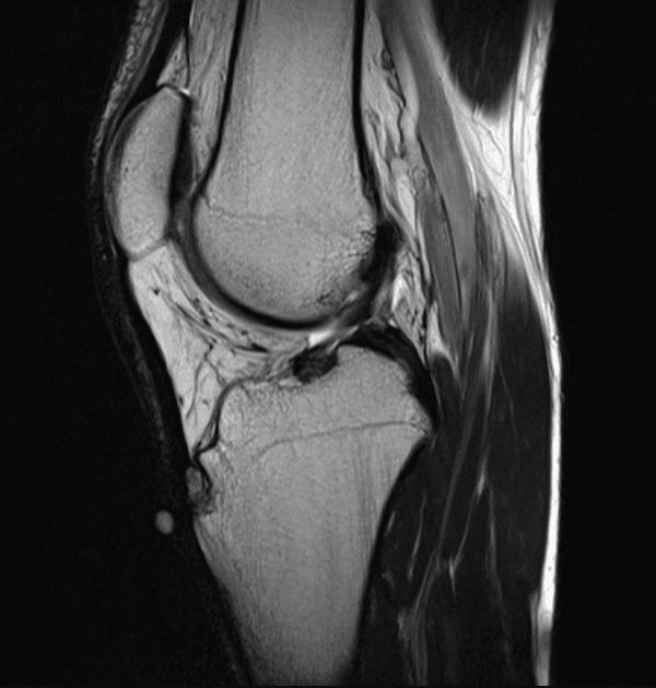 Osgood-Schlatter