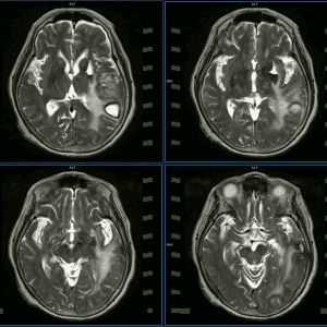 Huyết khối TM não