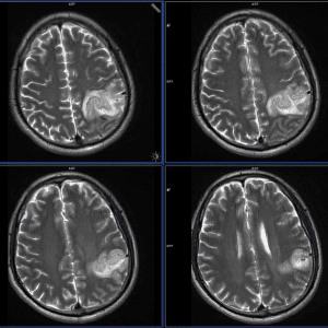 Huyết khối TM não