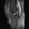 Osgood-Schlatter - Hình ảnh 3