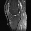 Osgood-Schlatter - Hình ảnh 4