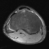 Osgood-Schlatter - Hình ảnh 5