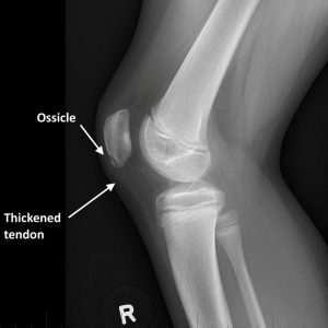 Bệnh Sinding-Larsen-Johansson