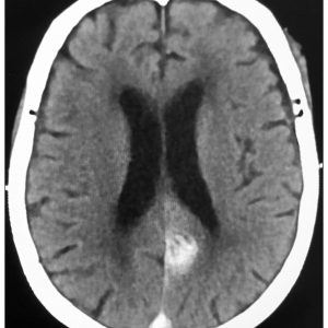 Huyết khối TM não