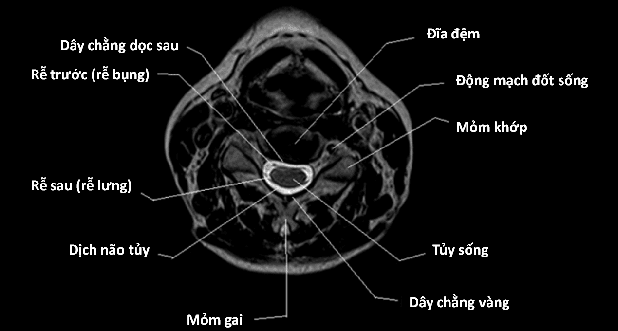 Tìm hiểu về giải phẫu mri cột sống thắt lưng và tầm quan trọng của nó