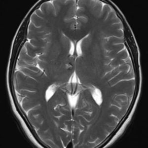 Cavernoma