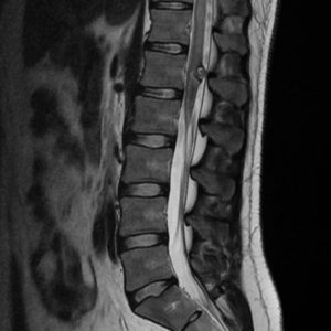 Cavernoma