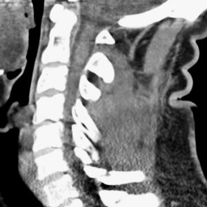Cavernoma