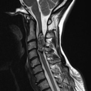 Cavernoma