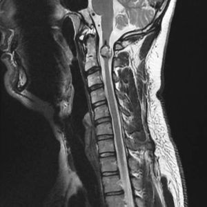Cavernoma