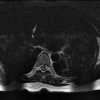 Cavernoma - Hình ảnh 2