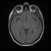 Cavernoma - Hình ảnh 3