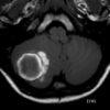 Cavernoma - Hình ảnh 2