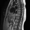 Cavernoma - Hình ảnh 3