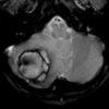 Cavernoma - Hình ảnh 3