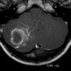 Cavernoma - Hình ảnh 4