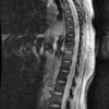 Cavernoma - Hình ảnh 5