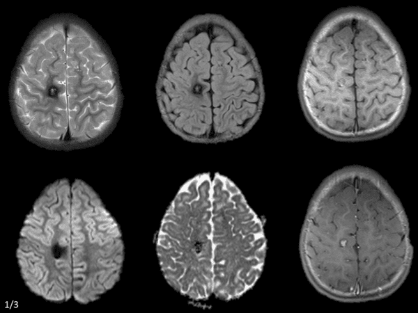 Cavernoma