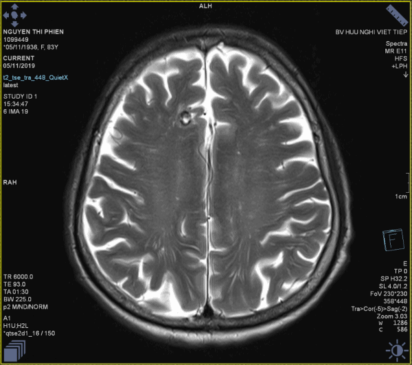 Cavernoma