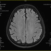 Cavernoma - Hình ảnh 2