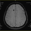 Cavernoma - Hình ảnh 3